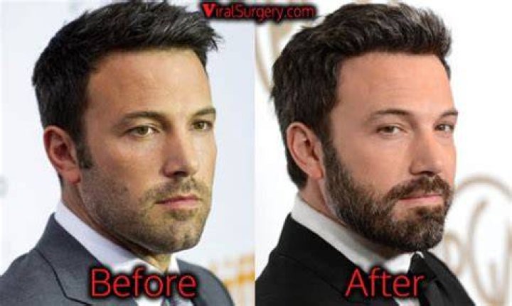 Ben Affleck Plastic Surgery Before and After