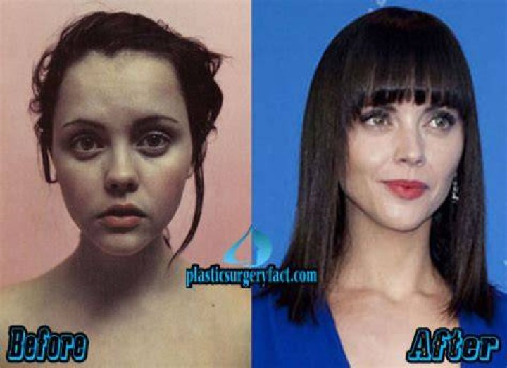 Christina Ricci Plastic Surgery Before and After